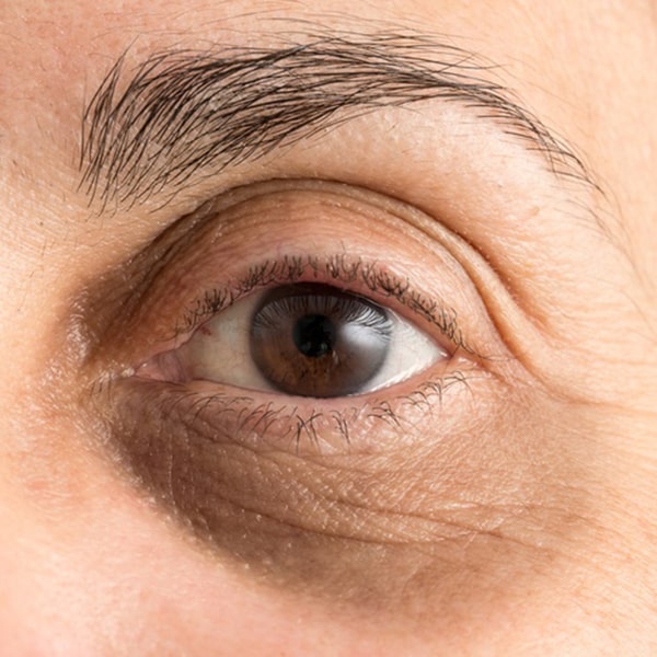 Eliminarea pungilor sub ochi cu Troxevasin - Inflamaţie 